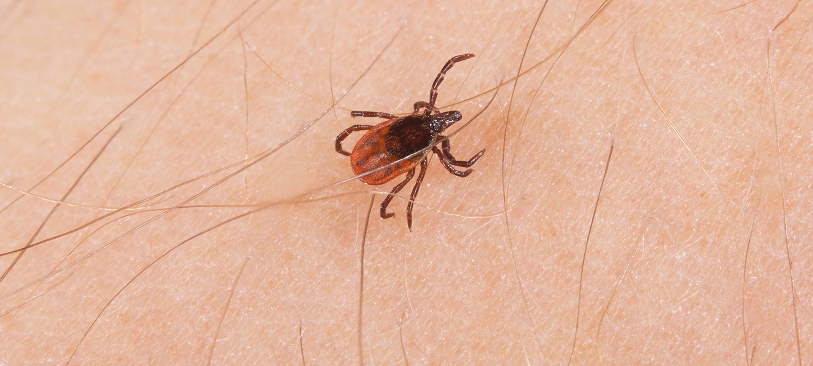 Zeckenbiss: Was muss ich tun?